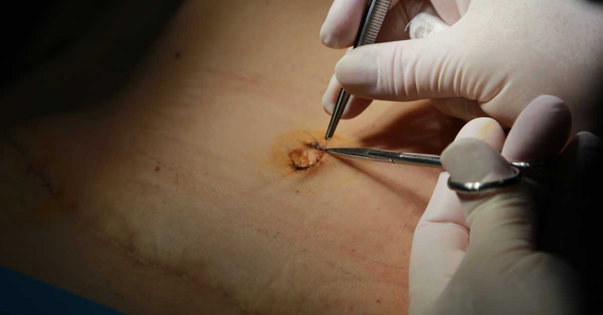 Belly Button Changes After a BBL