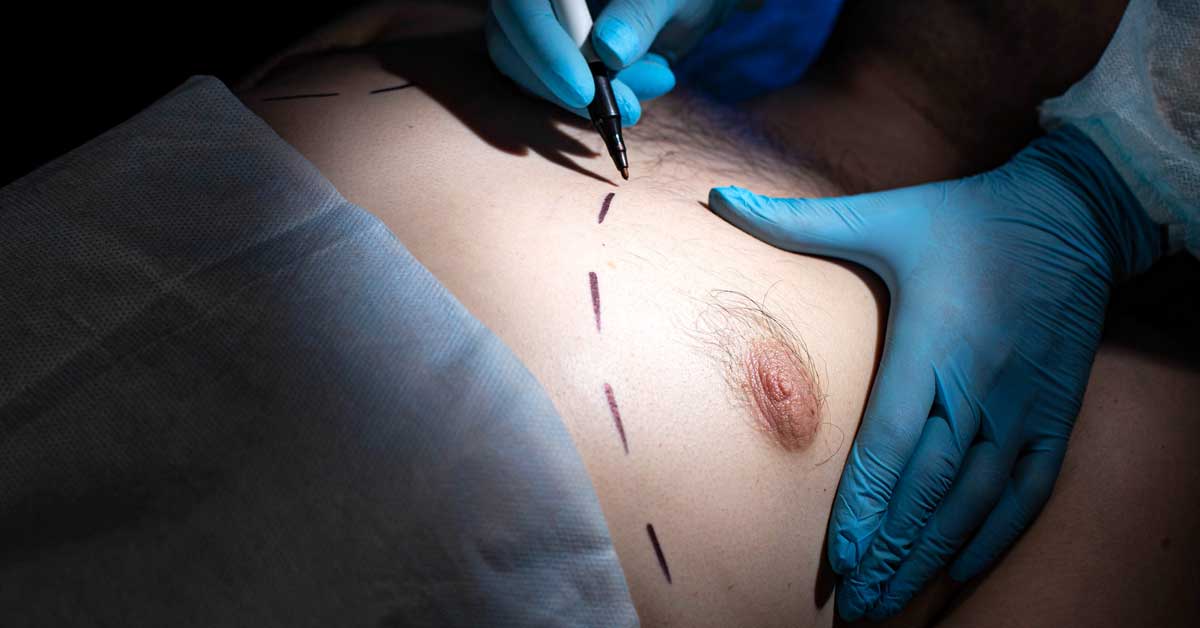 How to Get Rid of Puffy Nipples in Men