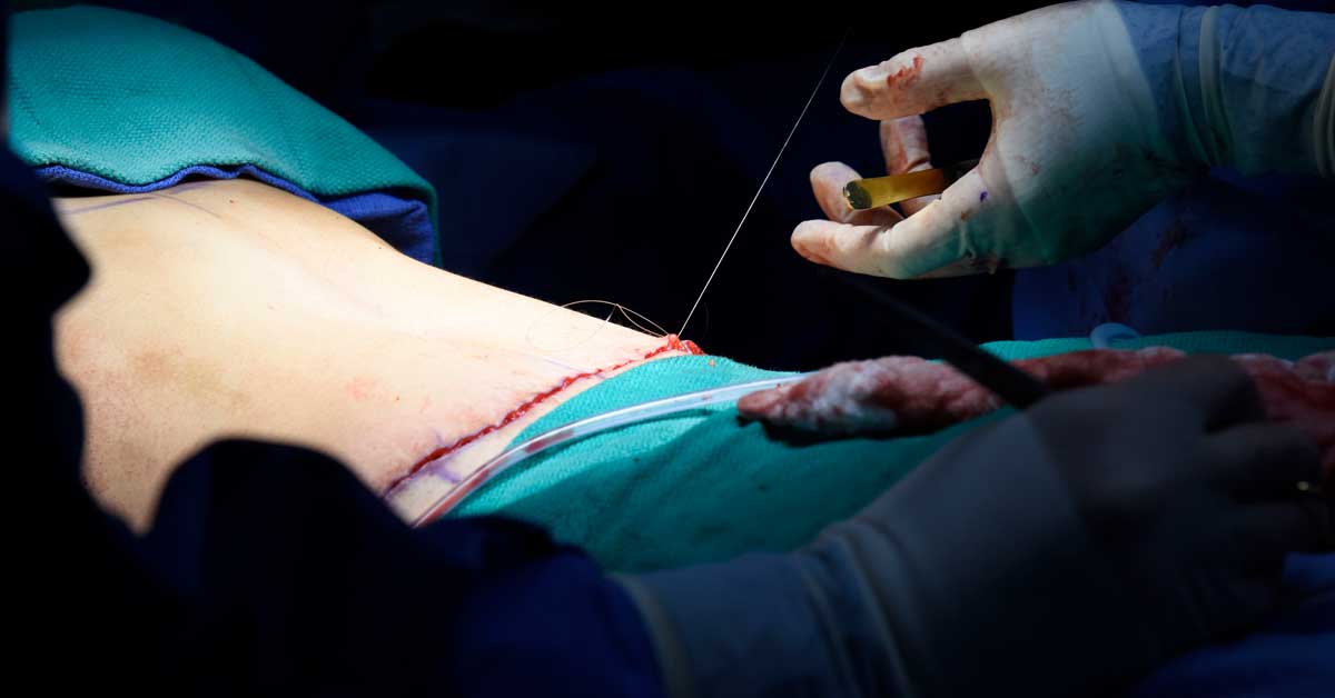 Tummy tuck