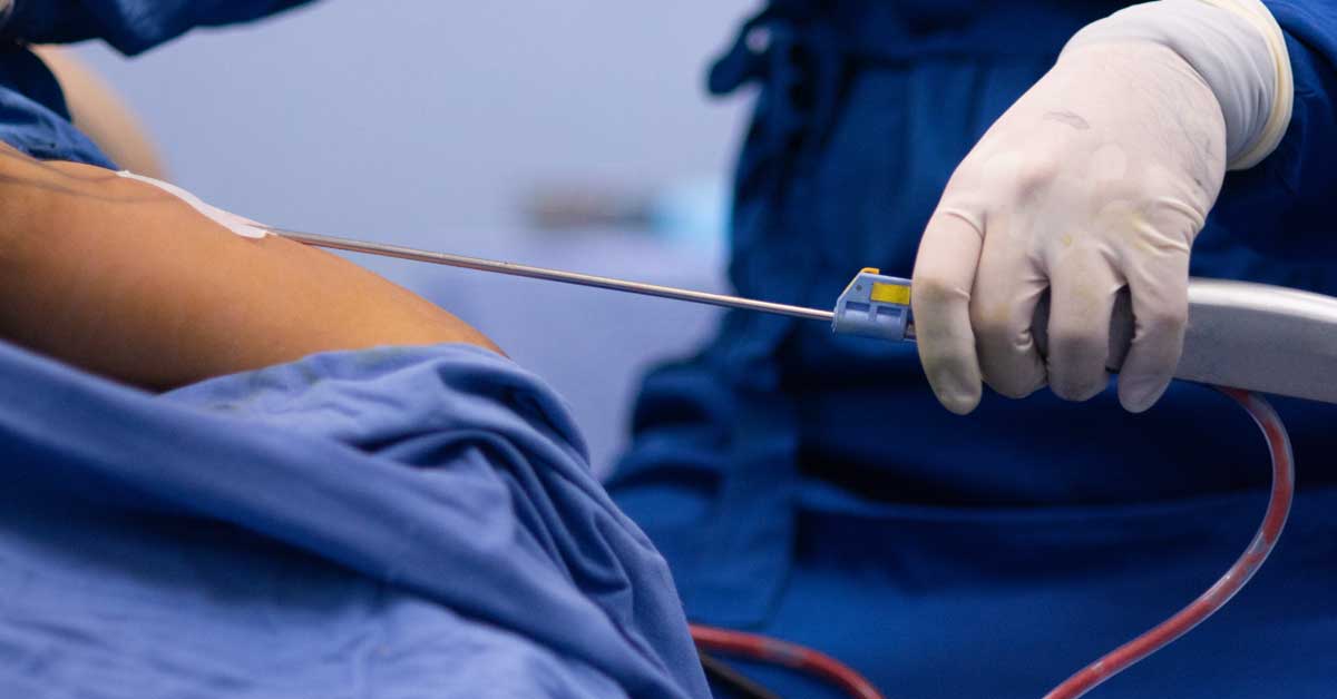 surgical liposuction tummy tuck