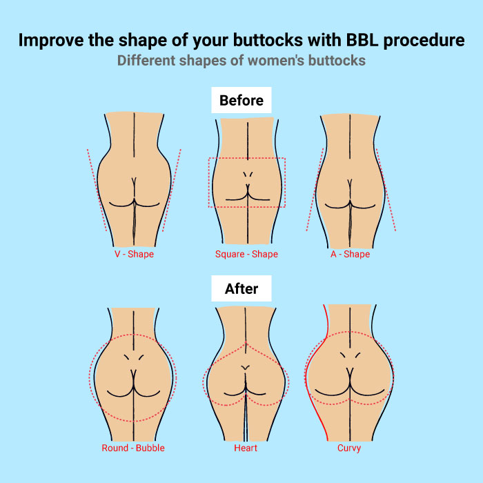 Graphic of Brazilian butt lift before and after images. | Seduction Cosmetic Surgery