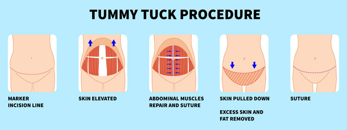 Tummy Tuck Procedure