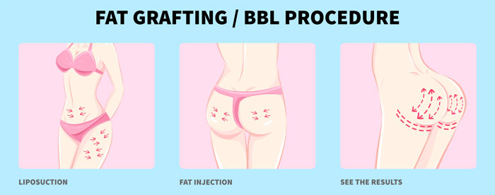Graphic of Fat grafting / BBL procedure. | Seduction Cosmetic Center
