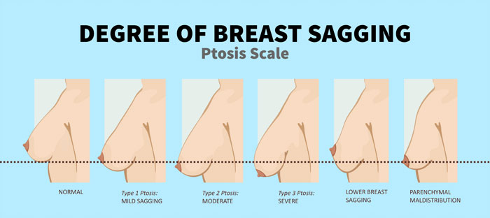 Graphic showing different degrees of breast sagging on a Protis Scale | Seduction Cosmetic Center