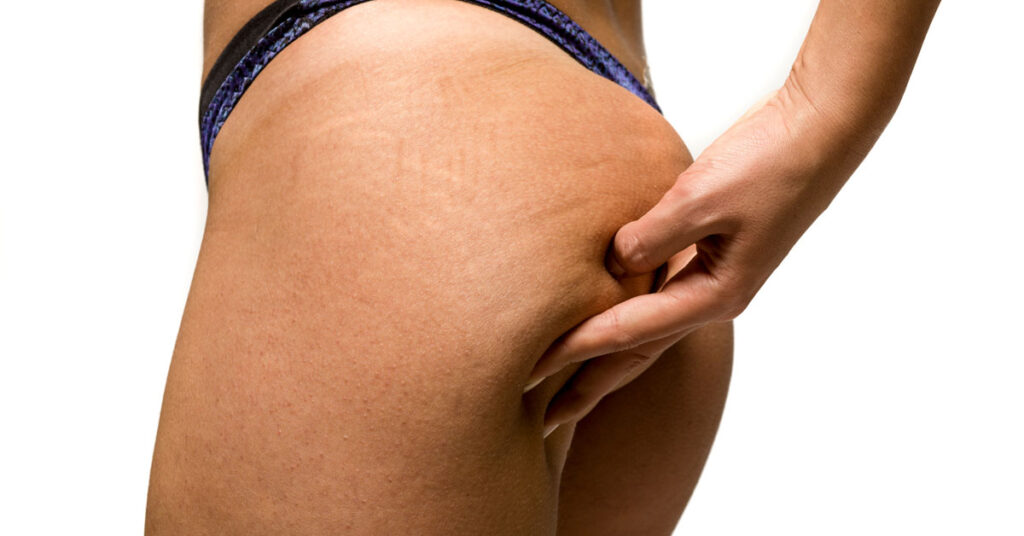 Sagging Buttocks After Weight Loss