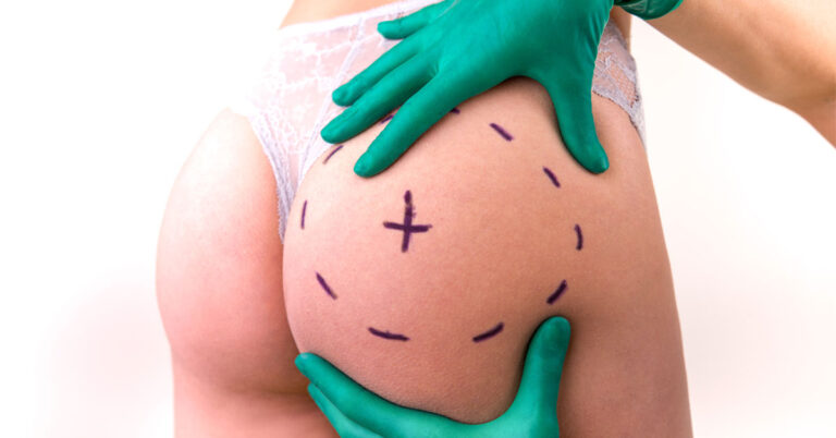 Sagging Buttocks After Weight Loss