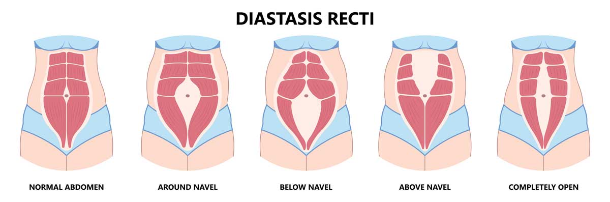 Diastasis Recti