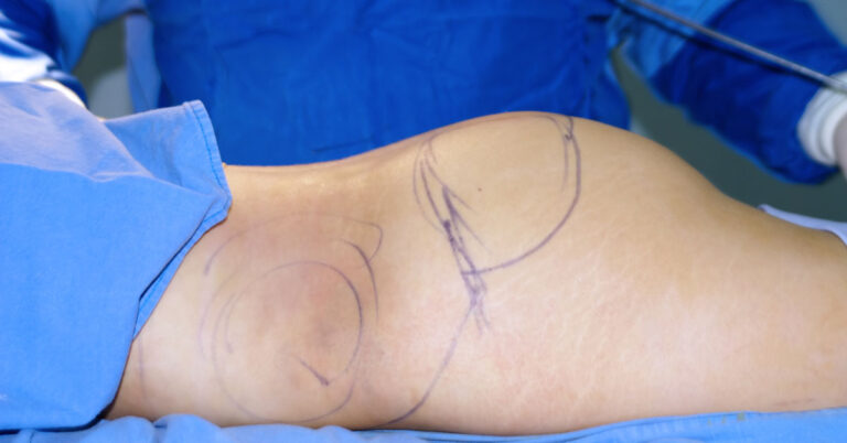 Fat Embolism Syndrome After BBL