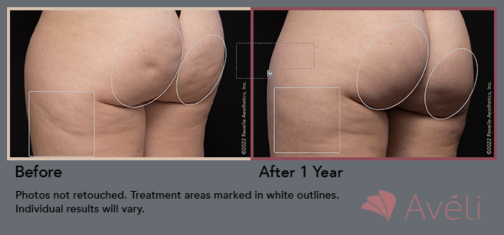 Side angle of Before and after Avéli™ Cellulite Treatment