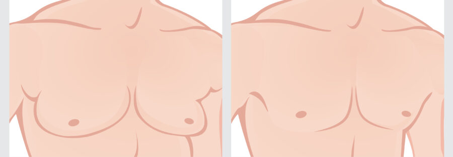 Male,Chest,Reduction.,Illustration,Of,Male,Chest,Before,And,After