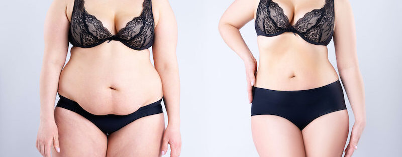 Tummy tuck vs liposuction
