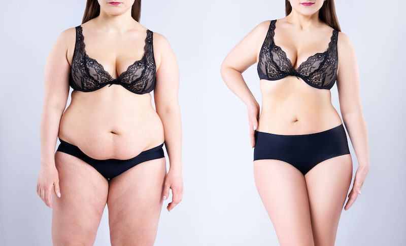 Tummy tuck vs liposuction
