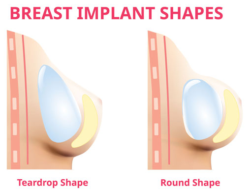 Breast Implants Shapes
