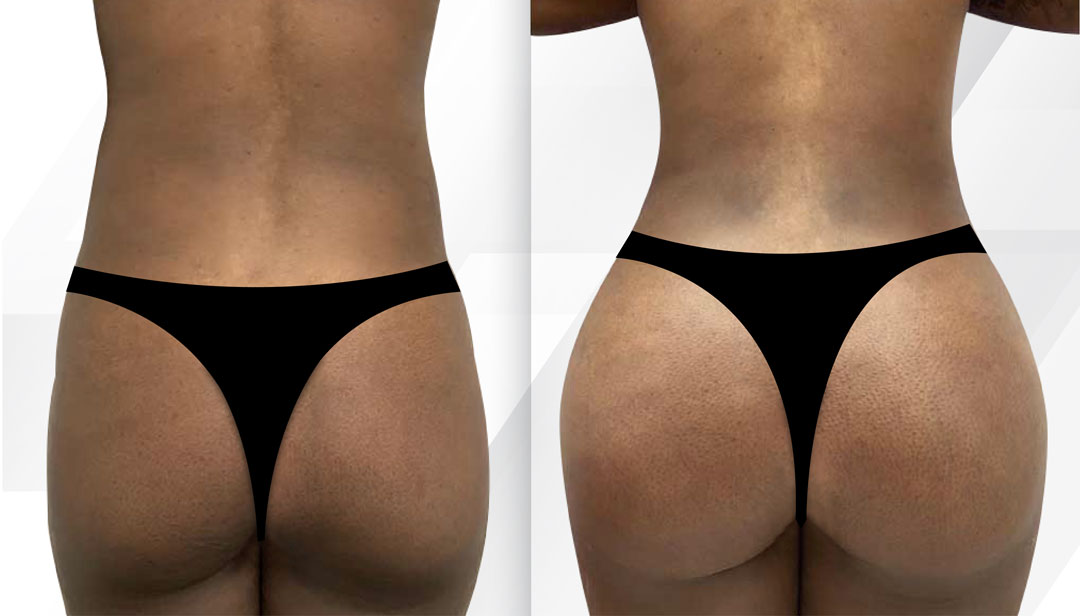 Watch One Woman Get A Transformational Brazilian Butt Lift in Miami