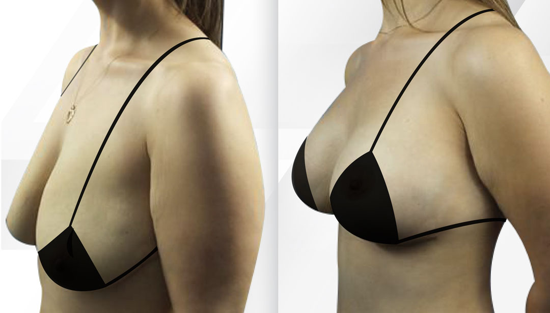 ▷ Breast Augmentation Miami ✔️ Breast Implants From ($2,800)