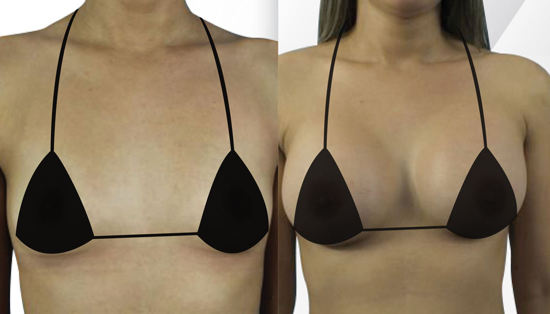 Bras After Breast Augmentation - Little Rock, AR - Dr. Suzanne Yee