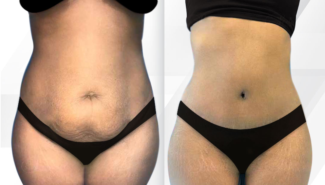 Plus Size Tummy Tuck Miami: Your Transformation from $5,500
