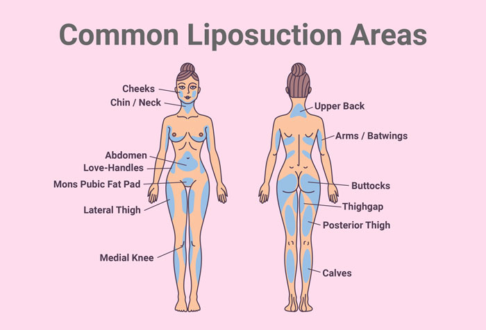 Liposuction Areas