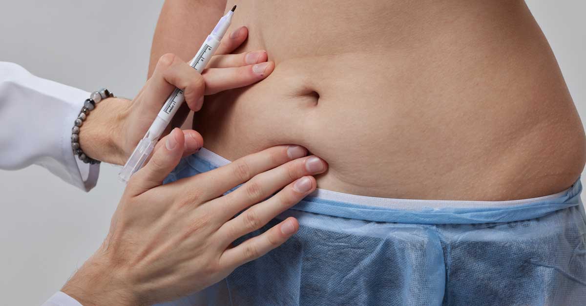 ▷ Belly Button Infected After Tummy Tuck: Understanding and Managing