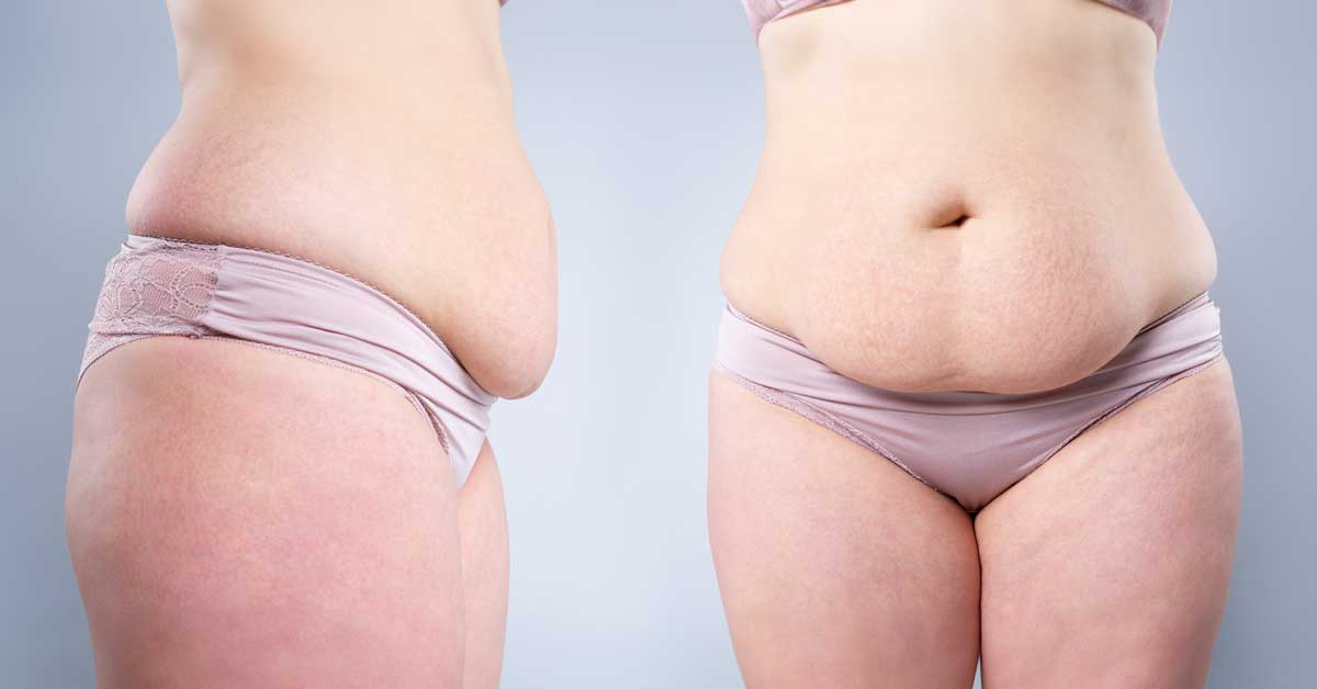 Scarless Tummy Tuck: Is It Possible?