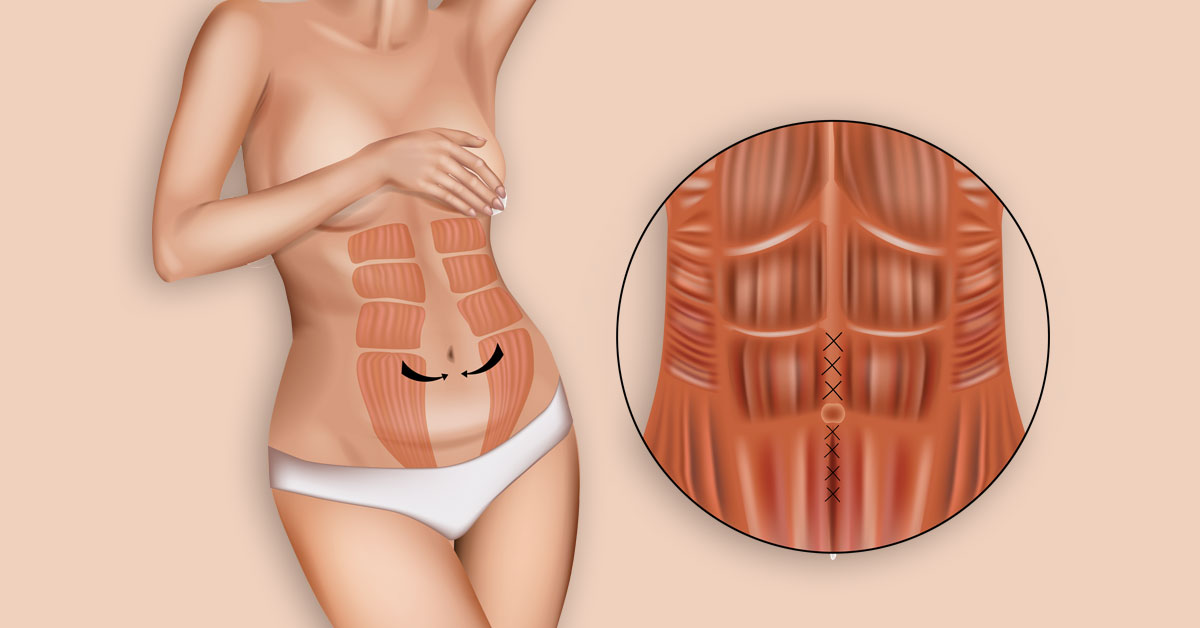 Scarless Tummy Tuck: Is It Possible?