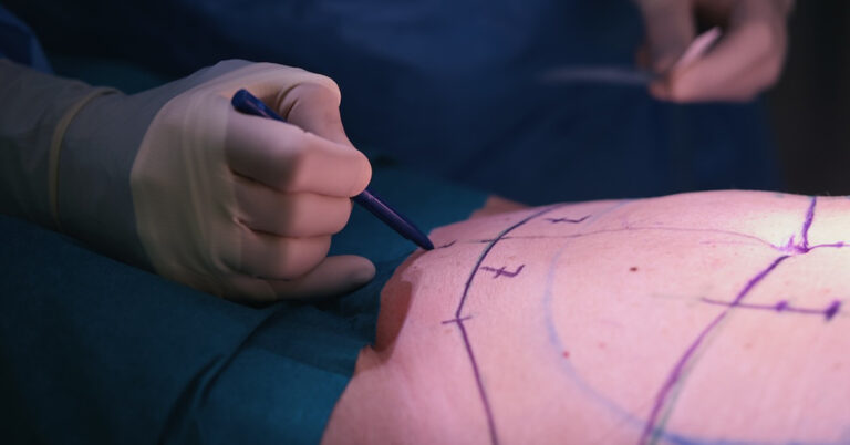 Doctor marking cutting lines for tummy tuck