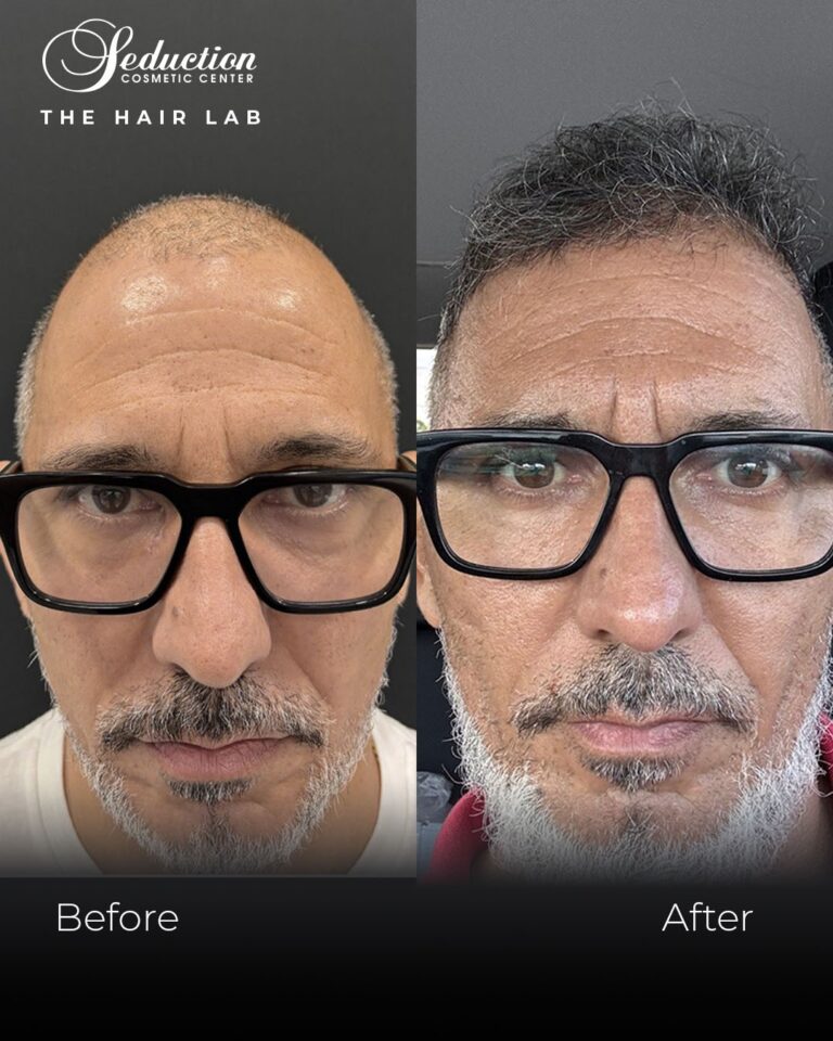 before-geter-hair-transplant-seduction